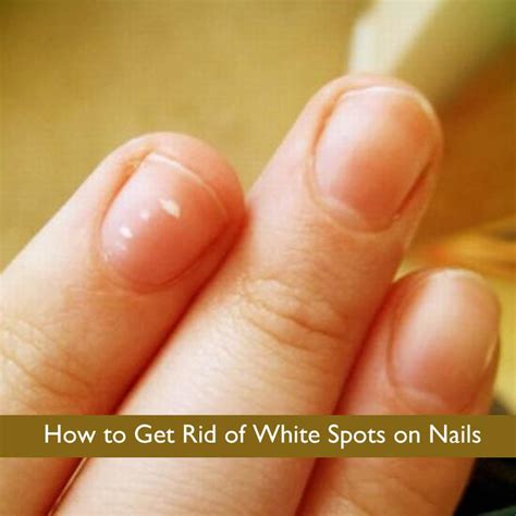 How To Get Rid Of White Spots On Nails Iherb Scoopnest