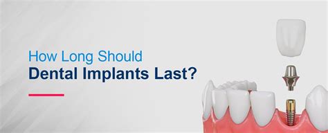 Dental Implants How Long Should They Last Hiossen Implant