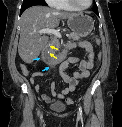 Gallstone Pancreatitis Post Cholecystectomy Eurorad