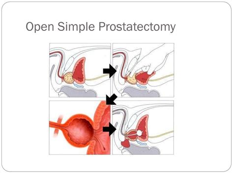 PPT Neoplasms Of The Prostate Gland PowerPoint Presentation Free