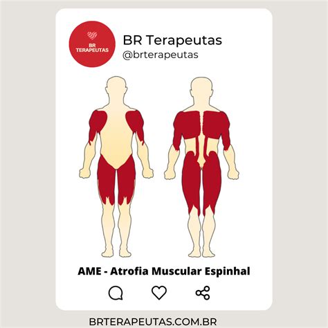 Atrofia Muscular Espinhal Sintomas