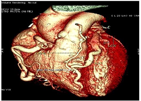 Anomalous Origin Of Left Coronary Artery From Main Pulmonary Artery