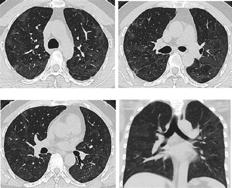 Chest Ct Scans On March 20th 2020 For The Same Patient Shown By Figs