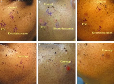 Figure 1 From Treatment Of Dermatosis Papulosa Nigra In 10 Patients A