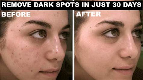 In Just 30 Days Remove Dark Spots Black Spots And Fade Acne Scars
