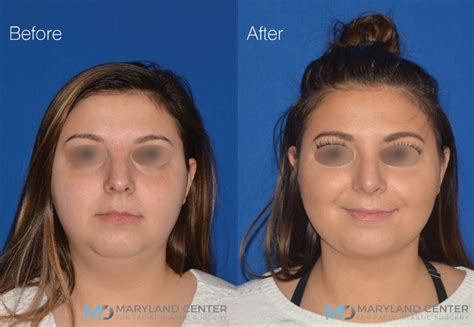 Facial Liposuction Case 2 Maryland Center For Facial Plastic Surgery