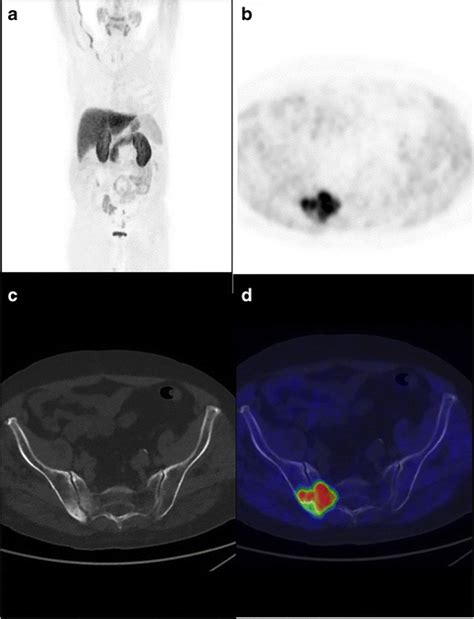 Mip Image A Pet B Ct C And Fused Petct D Axial Images Of A