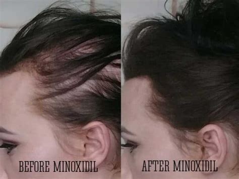 Get The Scoop On Minoxidil For Hair Loss Right Now Lewigs