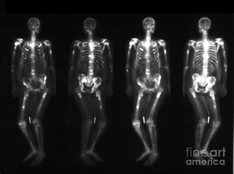 Bone Scan Showing Multiple Metastases 4 Photograph By Scott Camazine