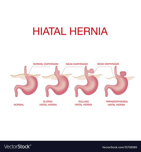 Poster Hernie Abbildung Hiatal Hernia Vector Diagram Of Normal Sexiz Pix