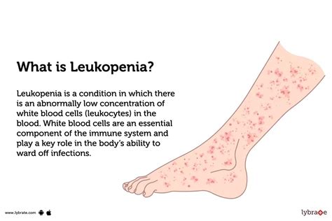Leukopenia Causes Symptoms Treatment And Cost