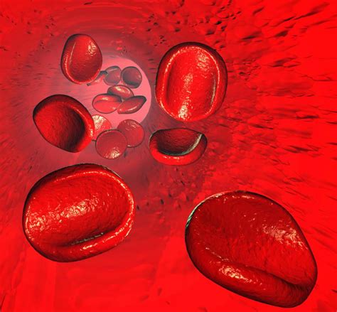 What Are The Causes Of Sickle Cell Anemia With Pictures