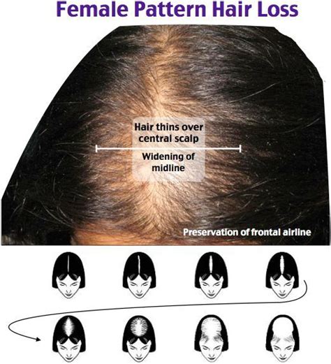 'but in babies who are predisposed to atopic eczema, this does not work as effectively, allowing loss of water from the corneocytes (cells in the skin), which shrink and allow cracks to open between them, so irritants and allergens can ­penetrate, leading to lesions from eczema. Female Pattern Hair Loss Rosh Review | Female pattern hair ...