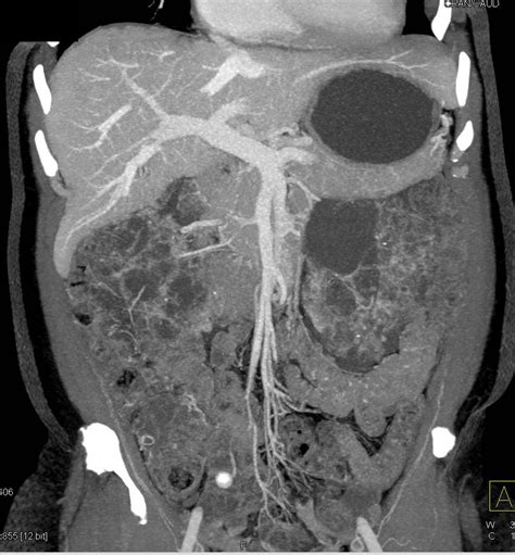 Polycystic Renal Disease And Polycystic Liver Disease Kidney Case