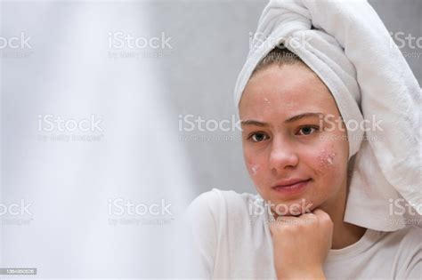 Acne Treatment A Teenage Girl Twisted Her Face Stock Photo Download