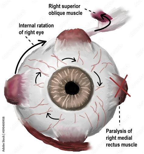 The Function Of Superior Oblique Muscle Of Right Eye In Eye Movement