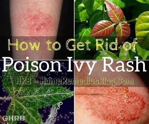 15 Best Home Remedies To Get Rid Of Poison Ivy Rash Poison Ivy Rash
