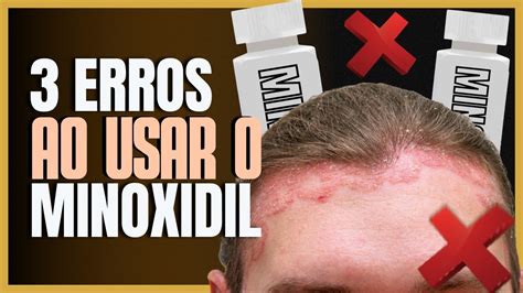 Erros Ao Usar Minoxidil