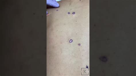 Back Extractions Cysts And Blackheads Kaado Md Youtube