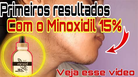 Evolução Minoxidil 15 Primeiro Resultados Do Minoxidil 15 Youtube
