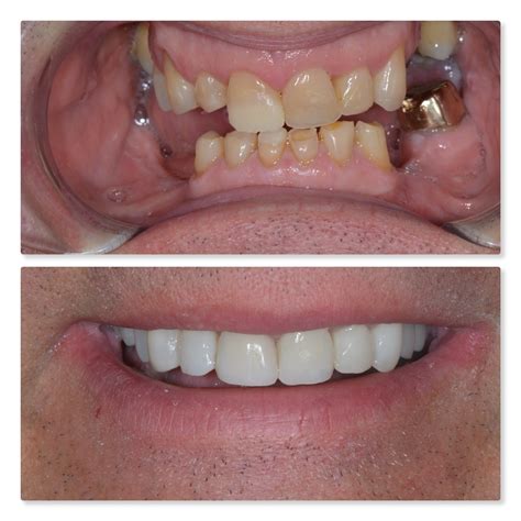 Tooth Implant Before After
