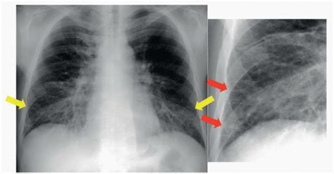 Pulmonary Edema Interstitial Radiology Key