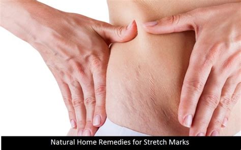 Natural Home Remedies To Get Rid Of Embarrassing Stretch Marks Healthy Tips