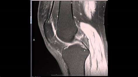 Introduction To Reading A Knee Mri Youtube