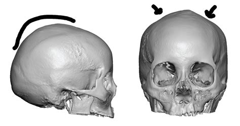 Plastic Surgery Case Study Female Crown Of The Skull Augmentation
