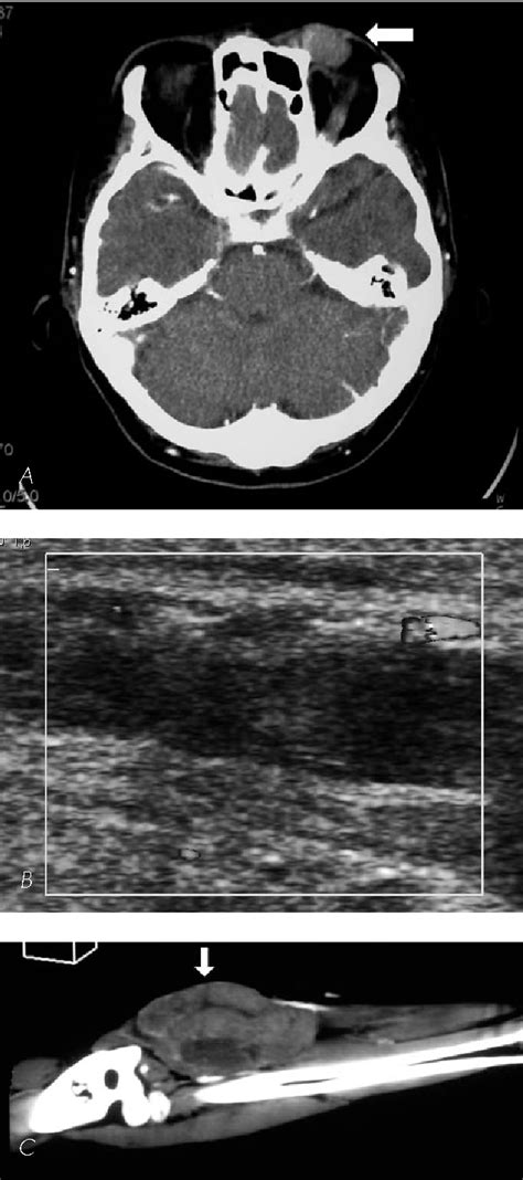 Figure 1 From Clinical And Radiological Study Of Three Cases Of