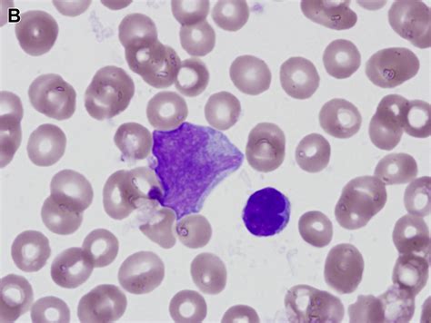 Early T Cell Precursor Acute Lymphoblastic Leukemialymphoma Surgical Pathology Clinics