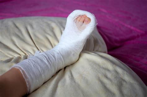 Broken Leg Cast In Bed