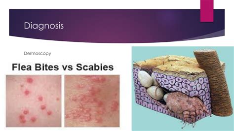Ppt Scabies Powerpoint Presentation Free Download Id244875