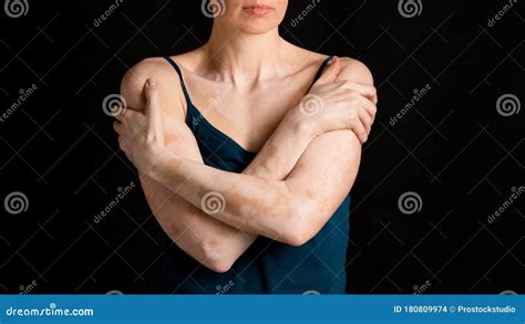 Woman Suffering From Chronic Skin Condition Problem Stock Photo Image