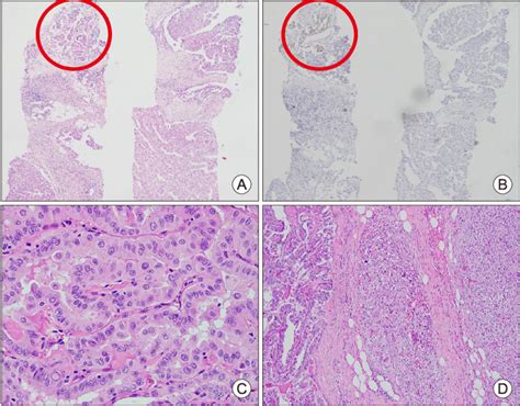 Pathology Finding Of Cervical Lymph Node Core Needle Biopsy Specimen