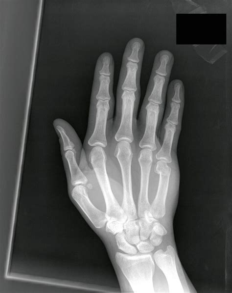 Clinical Cases And Images Boxer S Fracture