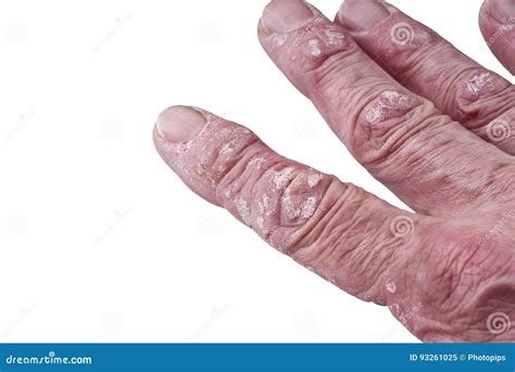 Psoriasis Skin Disease Stock Image Image Of Painful 93261025