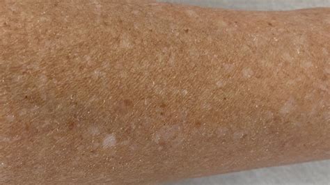 Hypomelanosis Punctata Oder Weiße Flecken Auf Der Haut