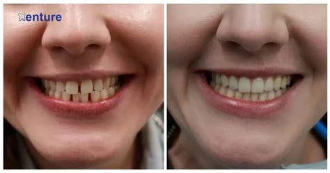 Are Veneers The Same As Dentures