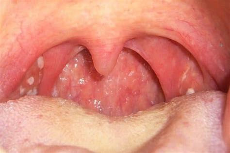 White Spots On Throat Causes Cancer Blisters No Pain No Fever Red