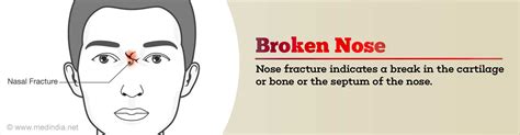 Broken Nose Nasal Fracture Age Groups And Types Symptoms