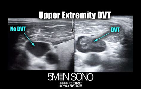 Upper Extremity Venous Ultrasound Protocol