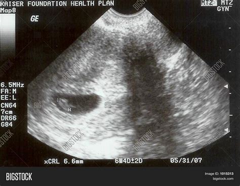 8 Week Ultrasound Image And Photo Bigstock