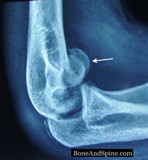 Capitellum Fracture Fixation Bone And Spine