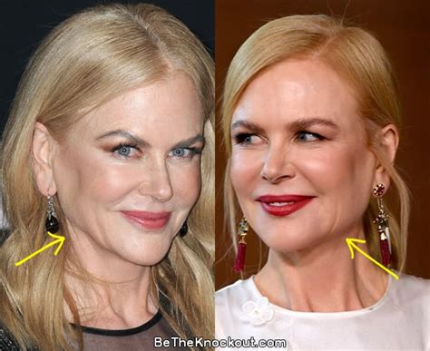 Nicole Kidman Plastic Surgery Comparison Photos