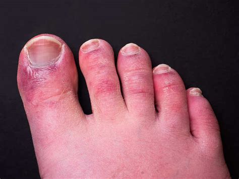 Rashes On Toe The List Of Virus Symptoms Keeps Getting Longer The