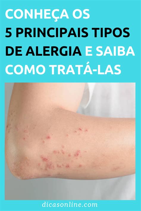 Como Tratar A Alergia Na Pele Com Remédios Naturais E Caseiros