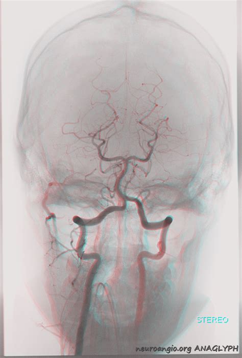 Occipital Artery