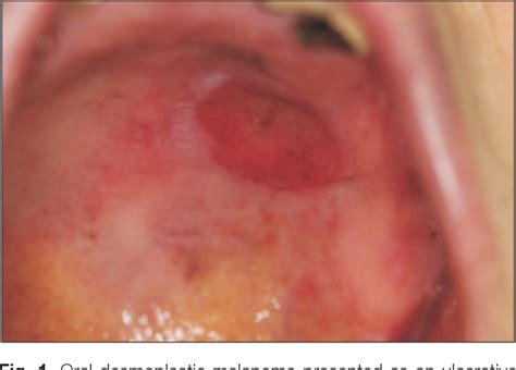 Figure 1 From Desmoplastic Melanoma Of The Oral Cavity Diagnostic