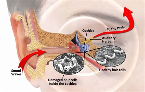 Noise Induced Hearing Loss Our Bend Or Practice Will Help You